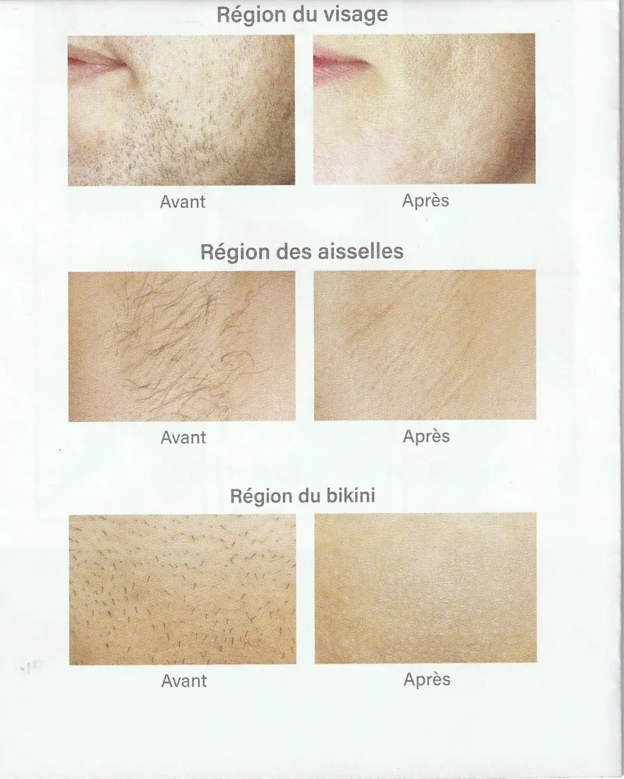 Épilation professionnelle